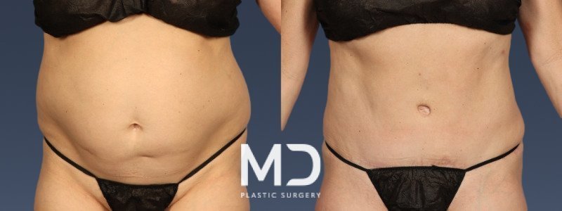 Tummy Tuck 2 Combined Image