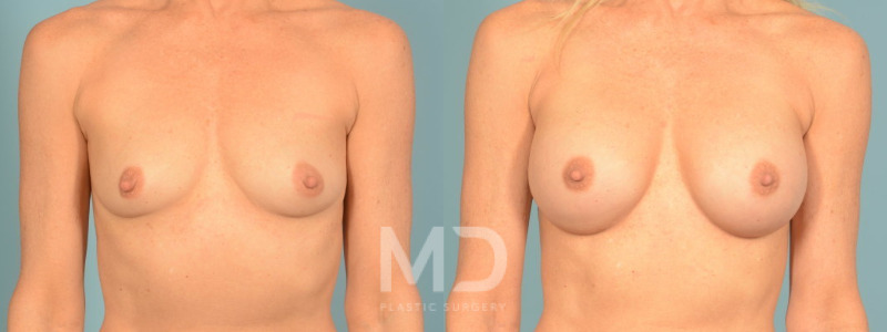 Breast Augmentation + Lift 8 Combined Image