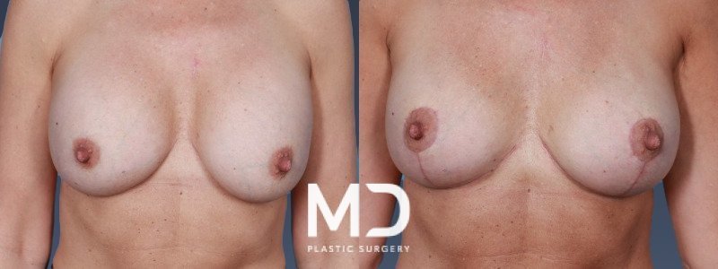 Breast Lift 5 Combined Image