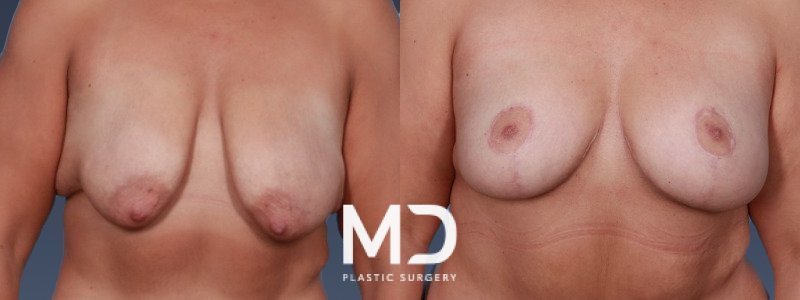 Breast Lift 1 Combined Image