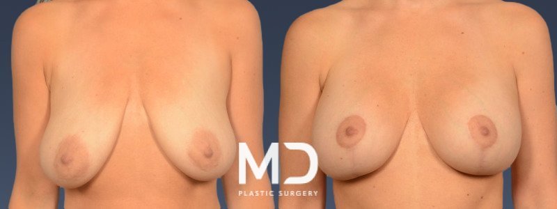 Breast Augmentation + Lift 9 Combined Image