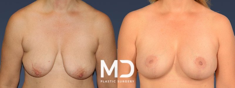 Breast Augmentation + Lift 10 Combined Image