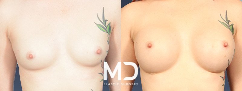 Breast Augmentation 3 Combined Image