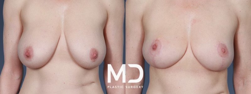 Breast Reduction 1 Combined Image