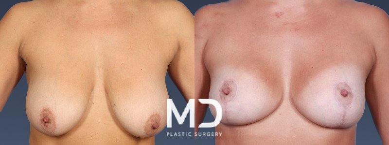 Breast Reduction 4 Combined Image