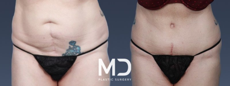 Liposuction 4 Combined Image