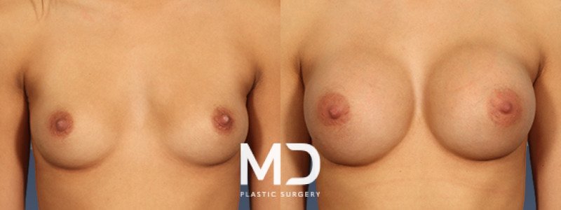 Breast Augmentation 2 Combined Image